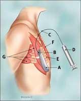 Side view of breast area with unfilled tissue expander in place.